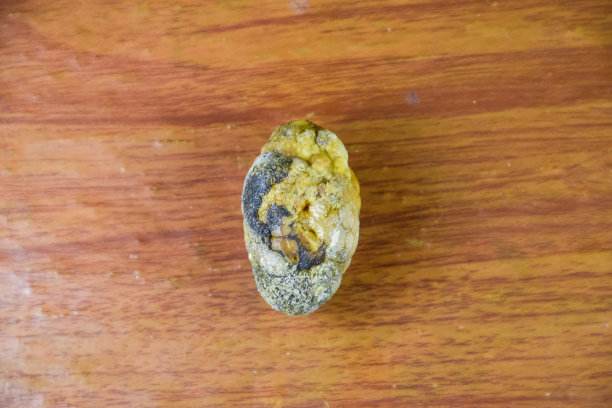 大型胆结石图片下载