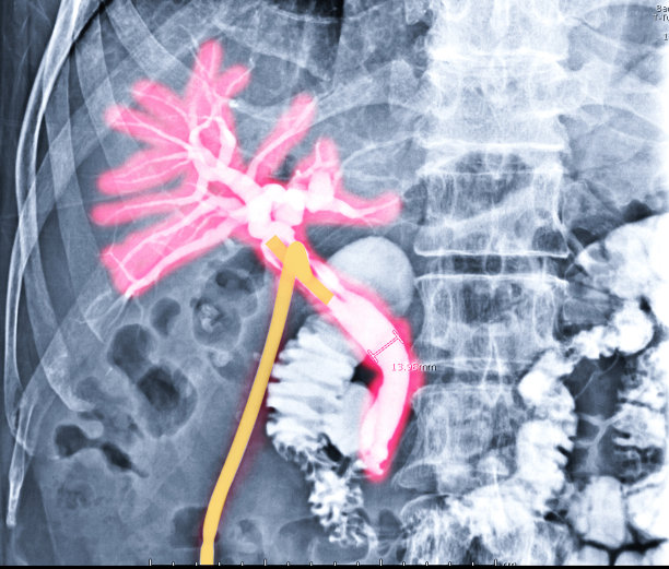 t管胆管造影是通过t管(黄色)将造影剂注入患者的胆道树的一种荧光透视术。图片下载