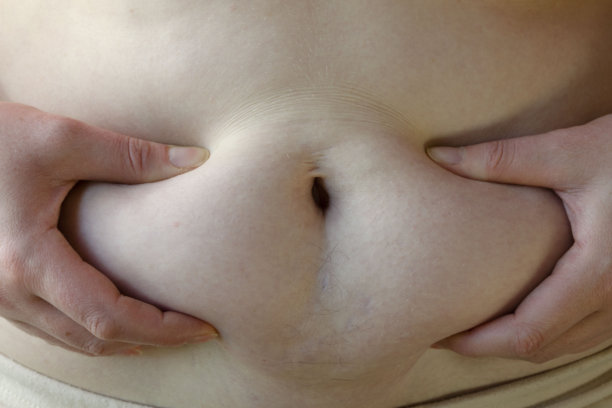 肥胖女性用手挤压腹部，使脂肪层清晰可见图片下载