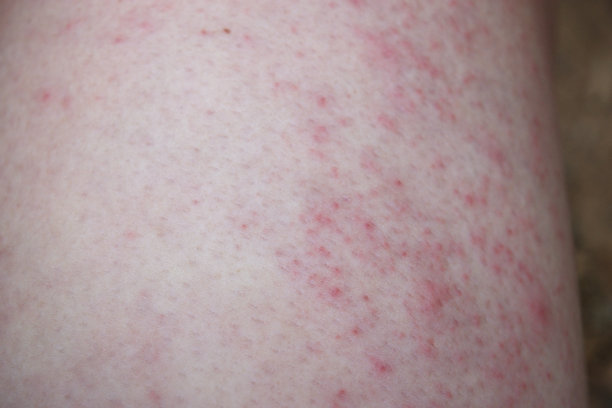 敏感皮肤上有痤疮、痱子或皮疹图片下载