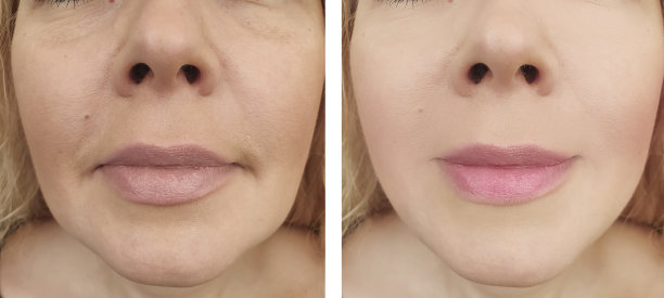 女性眼部皱纹前后再生程序图片下载