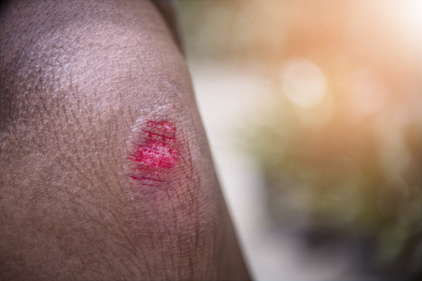 膝盖受伤，流血图片下载