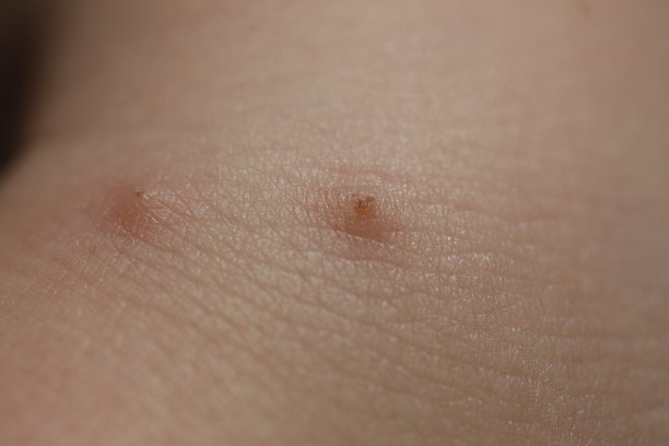 昆虫叮咬皮肤，孩子图片下载