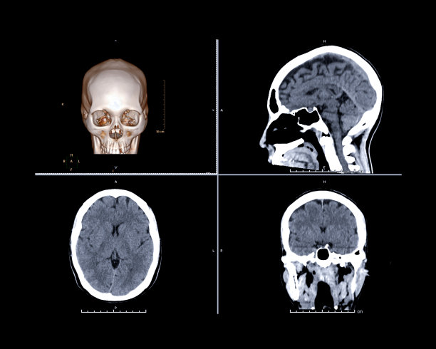 CT颅脑创伤对比三维渲染图像，矢状面，轴向面和冠状面筛查颅骨骨折。图片下载