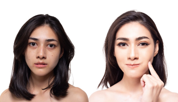 美容的概念。美丽的年轻亚洲女人有雀斑，斑点，痤疮和暗沉的皮肤，相比另一方面迷人的美丽女人有漂亮和明亮的皮肤的脸。有魅力的女孩会开心图片下载