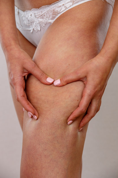 女孩展示了抱着和推着腿部脂肪团、橘皮的皮肤。治疗和处置多余的体重，皮下脂肪组织的沉积图片下载