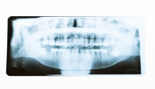 牙科x光片，白色背景图片下载