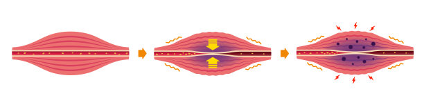 肌肉僵硬和疼痛过程说明(无文字)图片下载