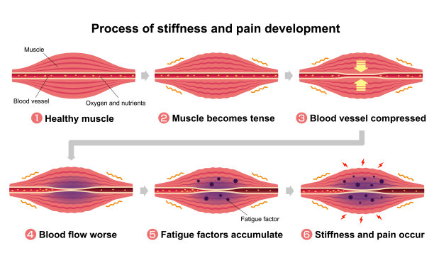 肌肉僵硬疼痛过程演示(6步)图片下载