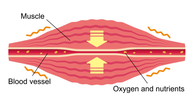 血管受压。肌肉和血管的平面插图。图片下载