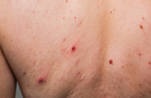 女孩背上有许多胎记。医疗卫生的照片。女性油性皮肤有粉刺问题。图片下载