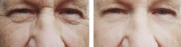 老人皱纹治疗前后图片下载