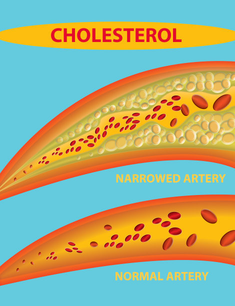 血管阻塞-胆固醇引起的动脉图片下载