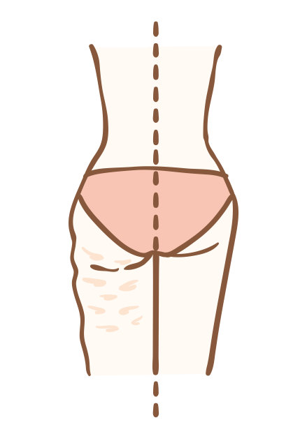 脂肪团去除前后图片下载