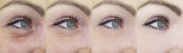 女人的眼睛皱纹前后拼贴图片下载