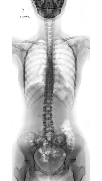 颈、胸、腰椎负片。图片下载