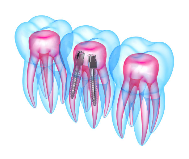 3d渲染的x射线牙齿与不锈钢牙科柱图片下载
