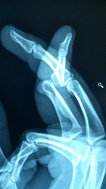 跖骨错位图片下载