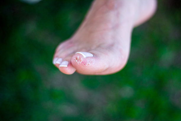 女性足指病图片下载