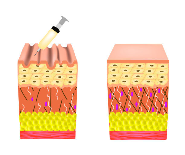 皮肤上的皱纹。肉毒杆菌素治疗皱纹。皮肤解剖结构。肉毒杆菌注射。信息图。矢量插图在孤立的背景。图片下载
