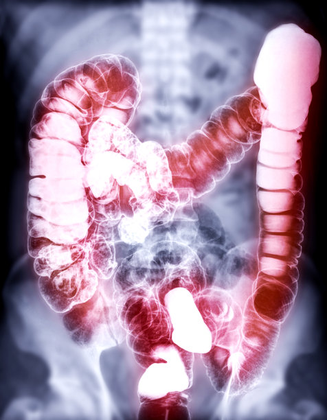 钡剂灌肠或BE是指在透视控制下，在结肠内注射钡剂填充后的大肠图像。图片下载