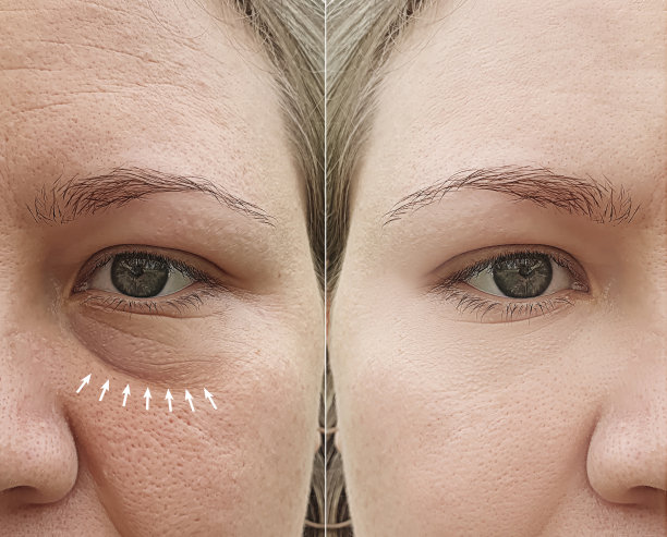 白种女孩面部皱纹去除后图片下载