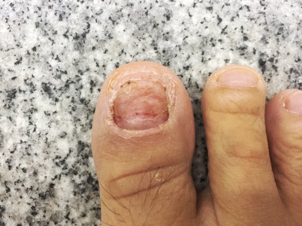 柔软聚焦脚趾甲提取液的背景图片下载