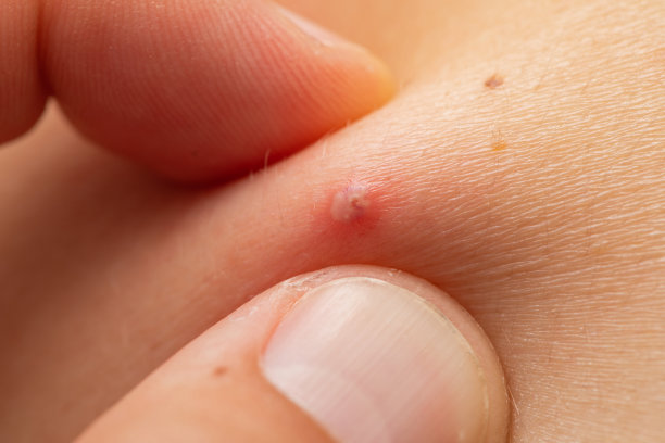 满是脓的红疙瘩图片下载