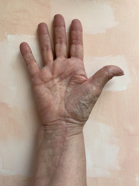 手和手腕疾病图片下载