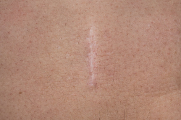 一个术后瘢痕疙瘩疤的特写在一个男人的腹部皮肤。图片下载