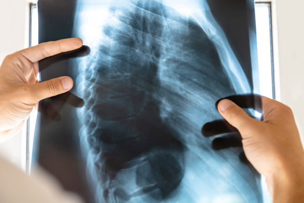 医生检查人体脊柱和胸部的x光照片图片下载
