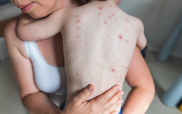 母亲安抚感染水痘带状疱疹病毒的儿子图片下载