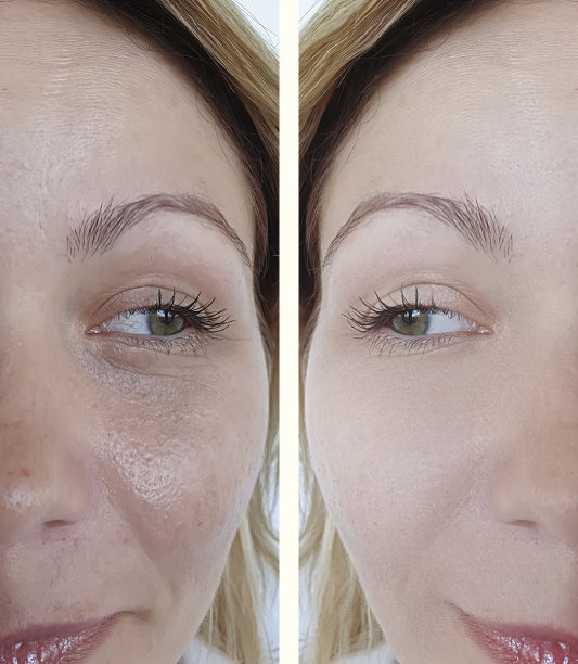 脸部妇女皱纹治疗前后图片下载