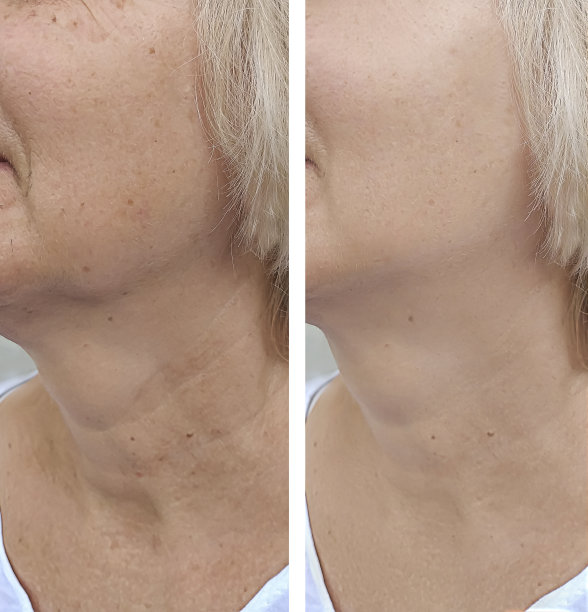 女性皱纹前后矫正图片下载