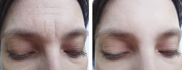 女性前额皱纹治疗前图片下载