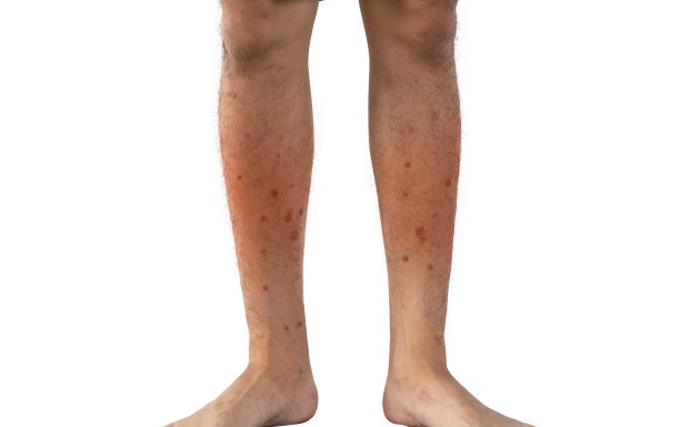 一个男人的腿与昆虫过敏的特写，蚊子，或虫咬孤立的白色背景。人体器官的一部分图片下载