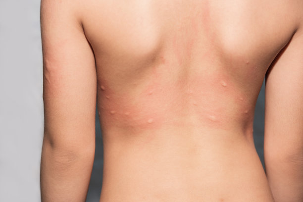 因昆虫叮咬或蚊子叮咬而在儿童皮肤上起疹子图片下载