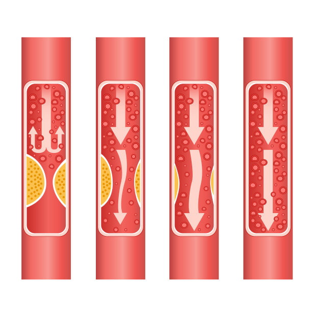 人类动脉粥样硬化库存图解图片下载