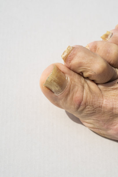 指甲真菌-甲真菌病导致腿指甲变形图片下载