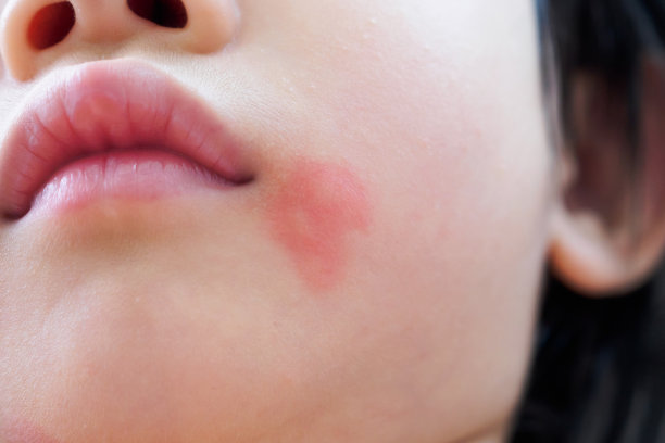 亚洲小女孩因面部被蚊子叮咬而出现皮疹和红斑过敏图片下载