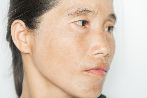女性面部黑斑及皮肤问题图片下载