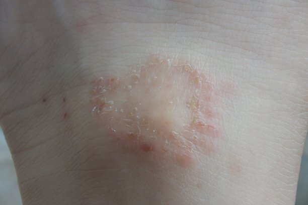 皮炎造成的皮肤伤口图片下载