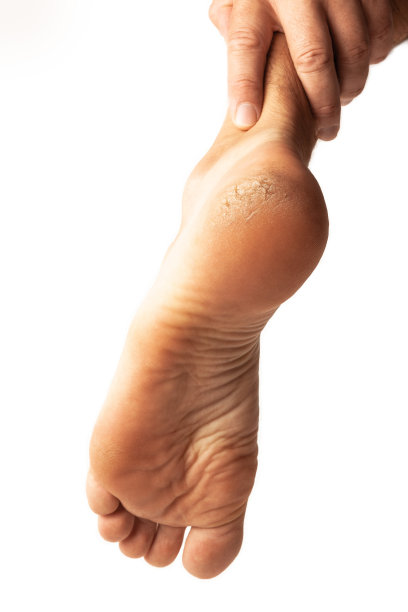 脚上皮肤干燥粗糙，白色背景下脚后跟开裂图片下载