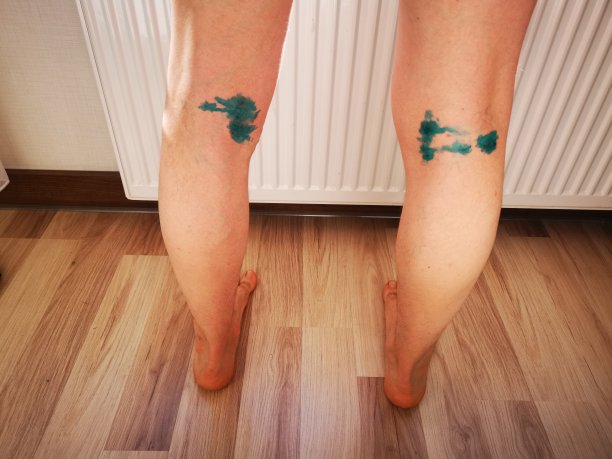 医疗程序后的双腿图片下载