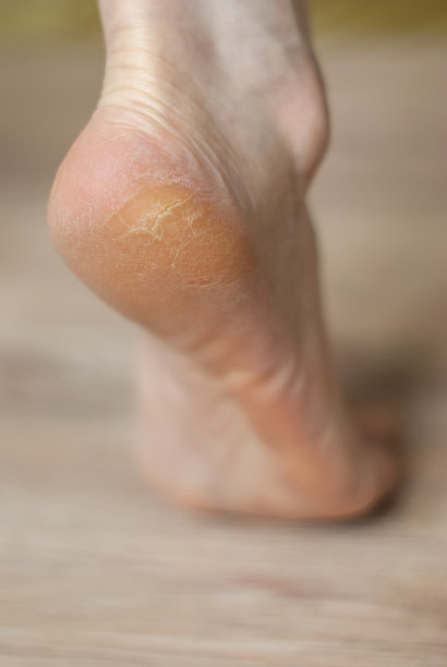 脚后跟有裂缝图片下载