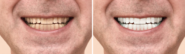 一个男人的牙齿治疗前后图片下载