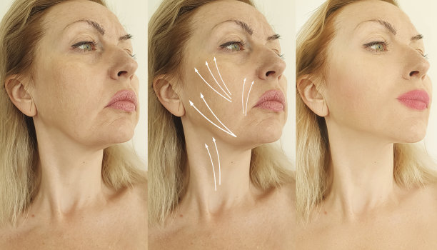 妇女皱纹治疗前后图片下载