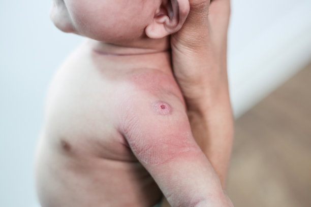 新生儿因注射而出现红点图片下载