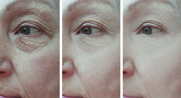 老年妇女皱纹治疗前后的眼睛图片下载