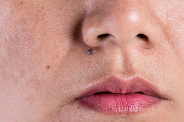 有问题皮肤和痤疮疤痕的女性。有问题的护肤和健康理念。皱纹，黄褐斑，黑斑，雀斑，皮肤干燥，色素沉着，亚洲女性。图片下载